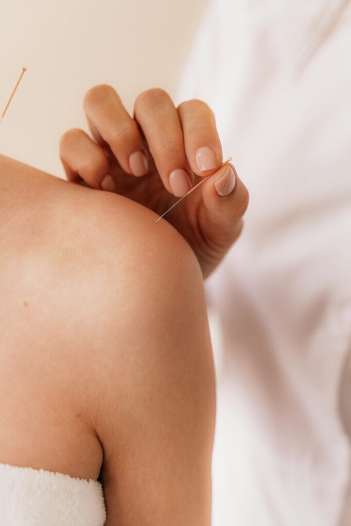 Accueil Close-up of acupuncture needle therapy on a patient