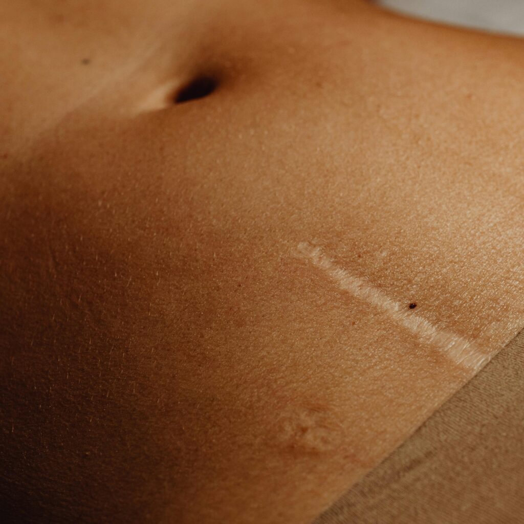 traitement des cicatrices par acupuncture