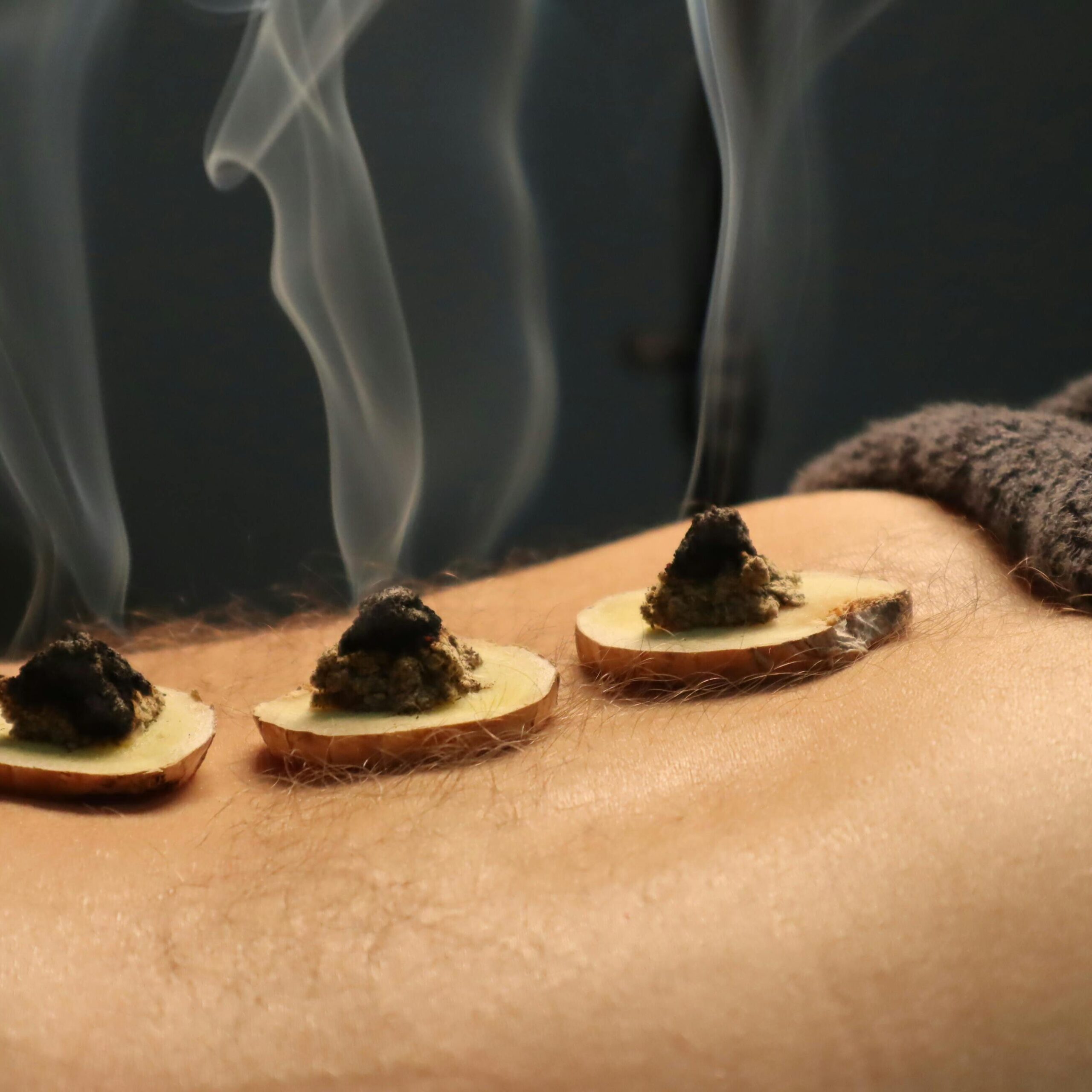 Close-up of traditional moxibustion therapy with smoke rising from moxa cones.