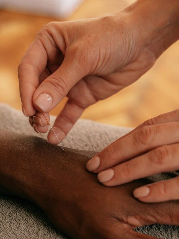 Hands inserting acupuncture needle in a therapy session, focused on alternative healing.