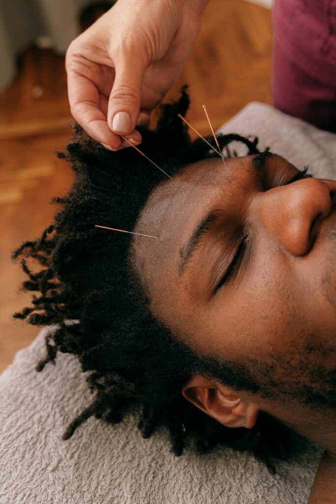 Close-up of acupuncture session with therapist inserting needles into a young man